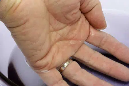 Refroidir le doigt pour retirer la bague