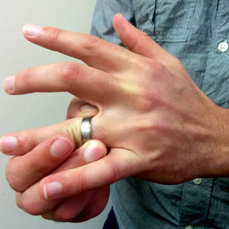 comment retirer une bague du doigt enflé